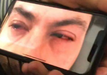 Enrique Peña Nieto sufre fuerte irritación en los ojos