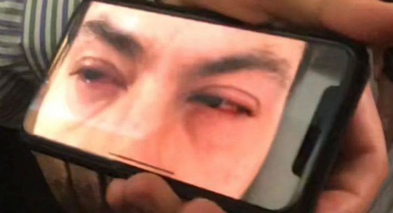 Enrique Peña Nieto sufre fuerte irritación en los ojos